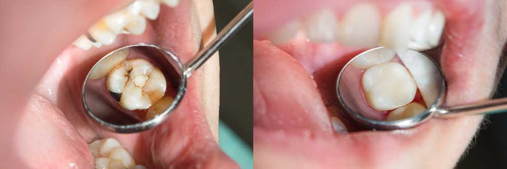 Modbury general dentistry filling before after