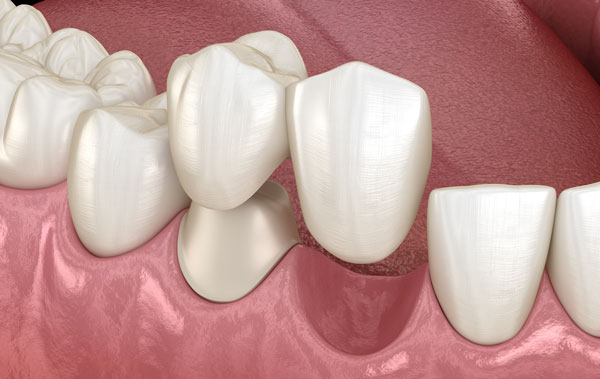 Dental bridge of 2 teeth over premolar
