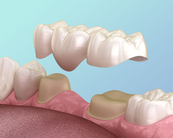 Dental bridge of 3 teeth