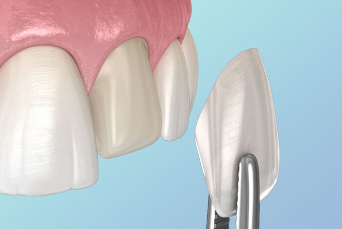 dental veneers placement upper tooth