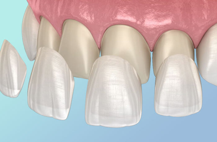 dental veneers placement upper teeth