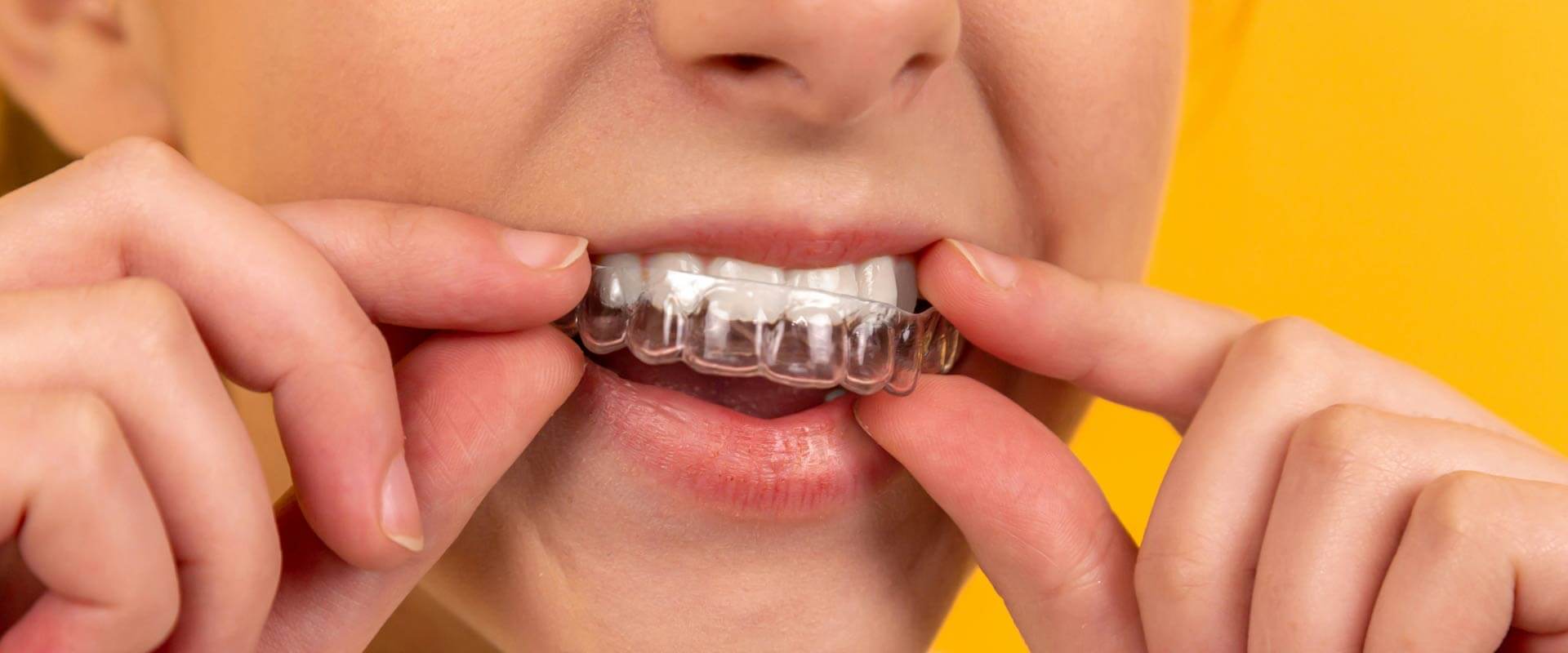 Custom teeth mouth guards are a part of preventive dental